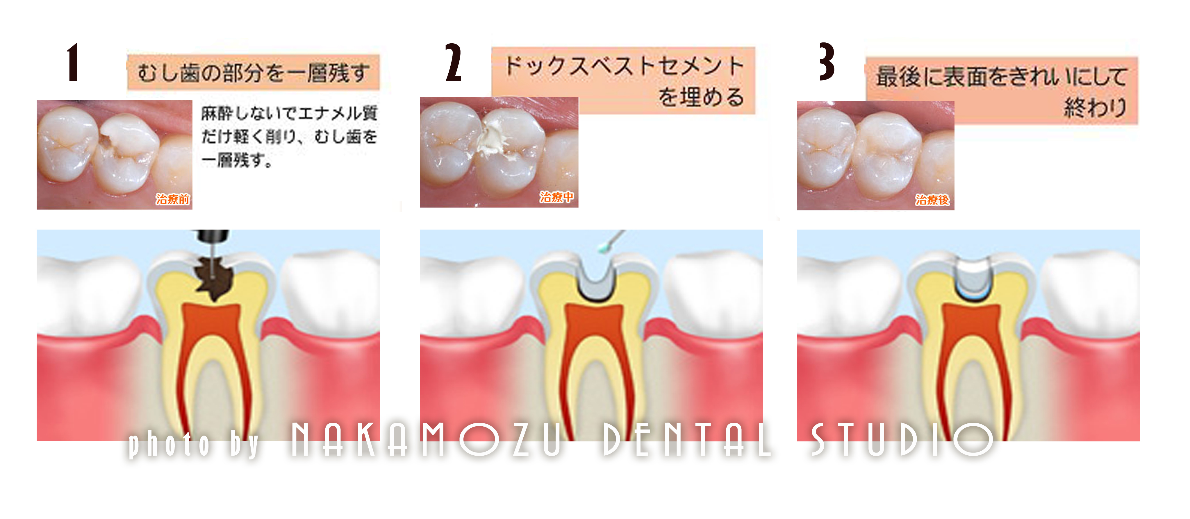 歯 の 神経 腐る 治療