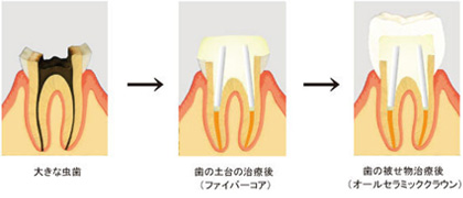 コアの選び方