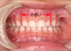乳歯と永久歯の大きさ
