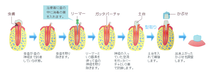 従来のむし歯治療