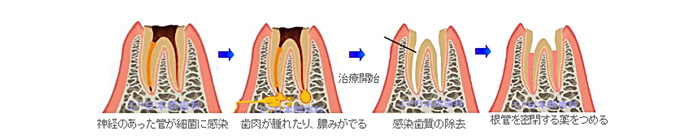 感染根管治療の流れ