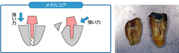 コアの種類