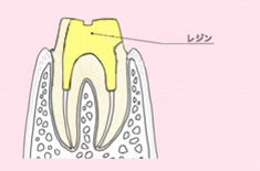 メタルコア