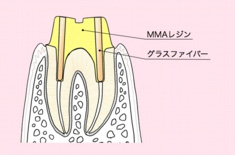 グラスファイバーコア