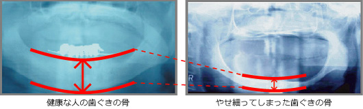 自由診療の入れ歯