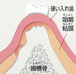 自由診療の入れ歯