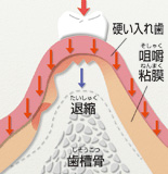 自由診療の入れ歯