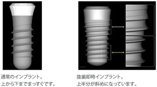 抜歯即時インプラント