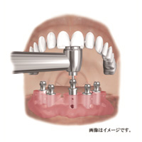 インプラントガイド