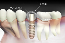 インプラント