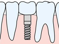 インプラント