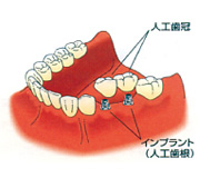 インプラント