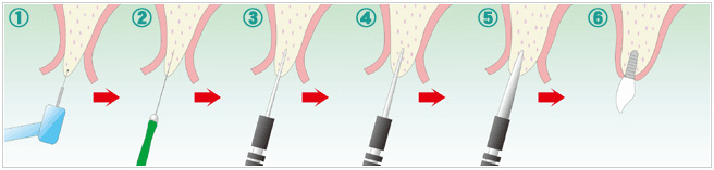 OAM式インプラント手術手順