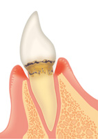 歯周病の治療法