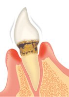 歯周病の治療法