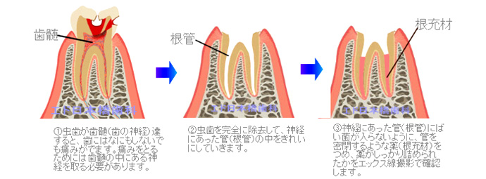 抜髄治療の流れ