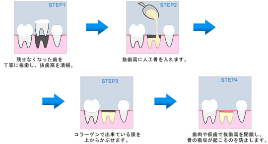 ソケットプリザベーション